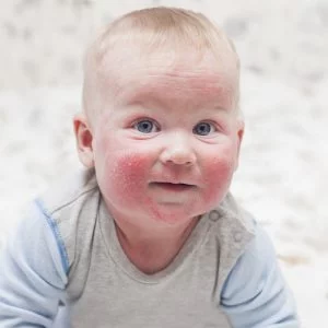 Baby mit atopischer Dermatitis