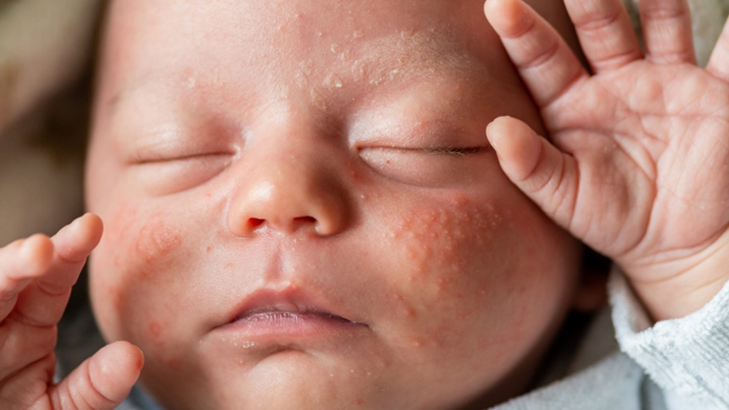 Neugeborene: Allergien & seltene Stoffwechselerkrankungen